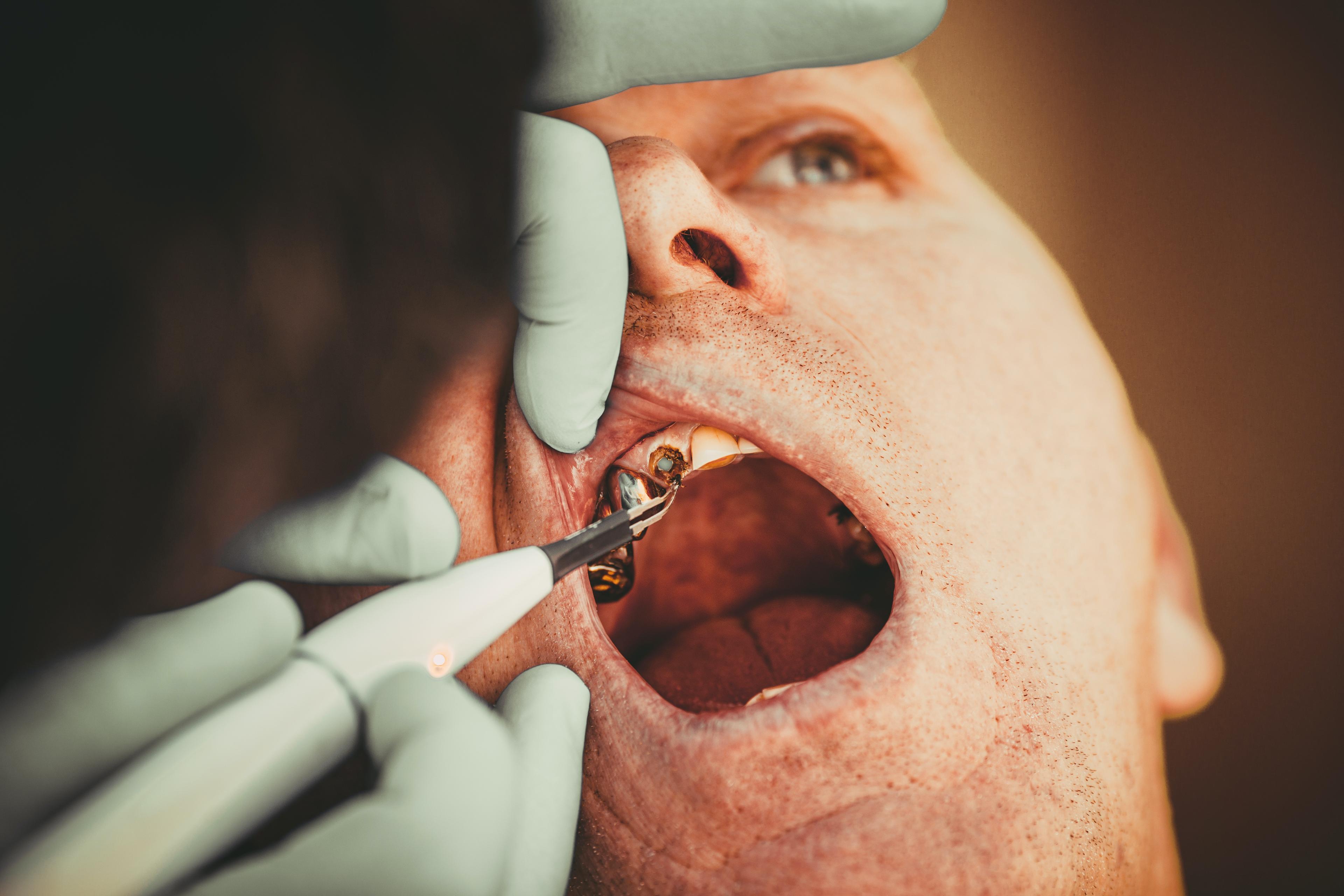 Próchnica początkowa - jak się zaczyna próchnica i na co zwracać uwagę? Zapobieganie próchnicy zębów mlecznych. Próchnica u dzieci - objawy i leczenie próchnicy zębów mlecznych. Jak wyleczyć próchnicę – skuteczne metody leczenia