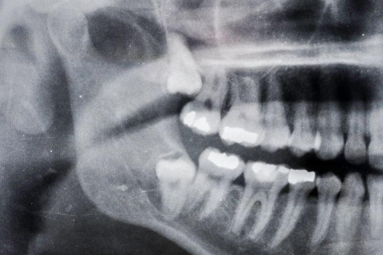 Ząb zatrzymany – co to jest? Jakie są dalsze kroki? Chirurgiczne usunięcie zęba. Chirurgiczne usuwanie zęba. Jak wygląda diagnostyka stomatologiczna? 