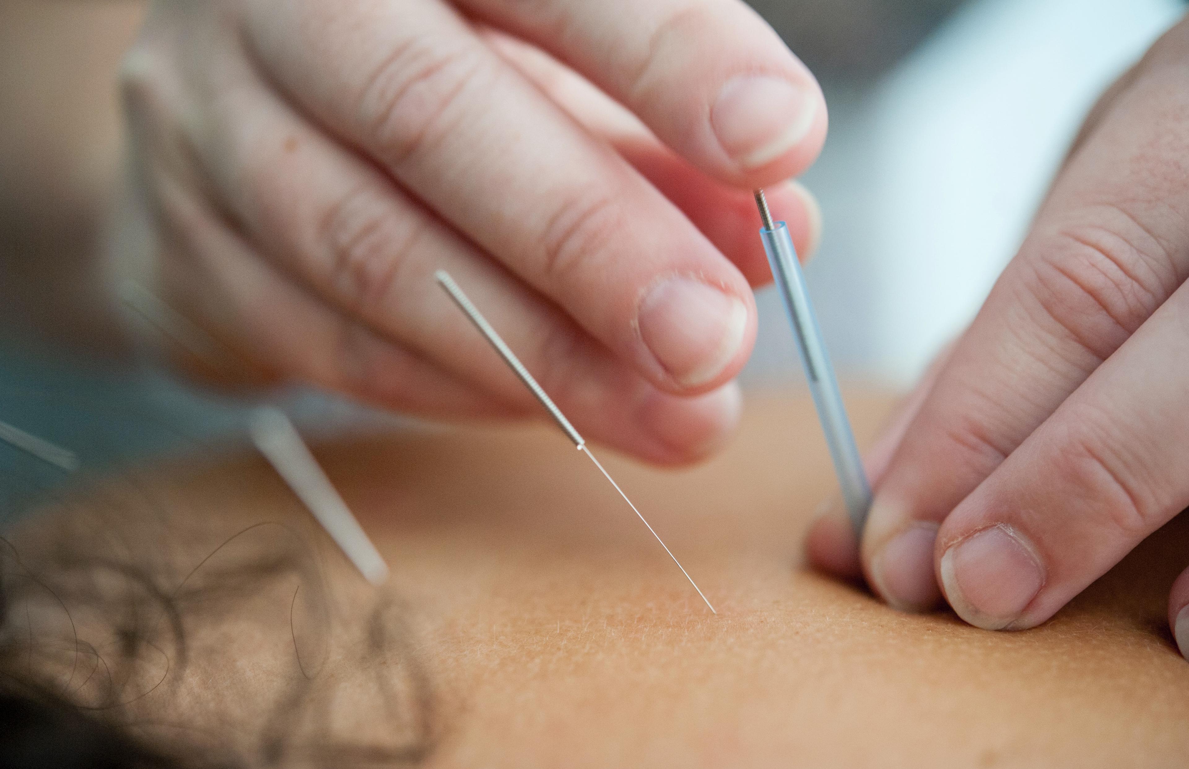 Akupunktura - co to i jak ją stosować? Akupunktura – na czym polega mechanizm jej działania? Kiedy stosować akupunkturę? Współczesna akupunktura – co leczy? Ile kosztuje zabieg nakłuwania skóry i tkanki podskórnej?