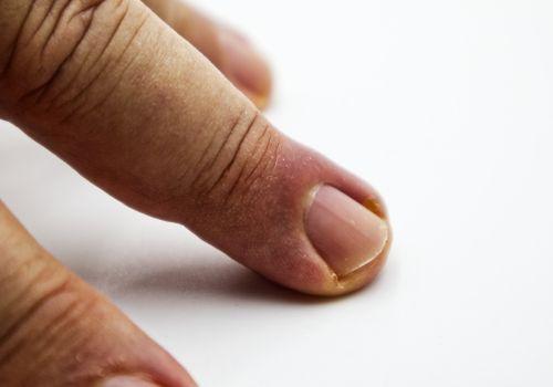 Jak wygląda zanokcica? Leczenie i sposoby domowe. Zanokcica - objawy, przyczyny i leczenie schorzenia. Zanokcica paznokcia – jak wygląda leczenie?
