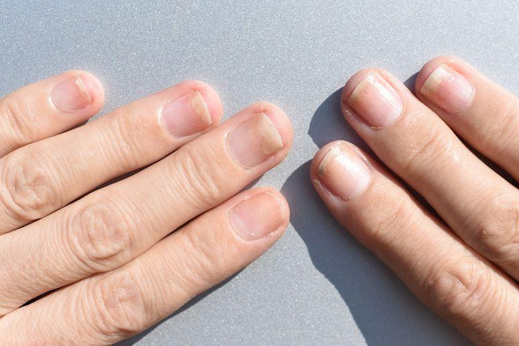 Czym jest onycholiza i jak ją wyleczyć? Czym jest onycholiza i jak ją leczyć? Onycholiza paznokci – czy to poważny problem?