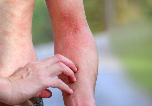 Jak sobie radzić z swędzeniem skóry?