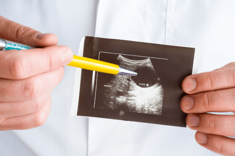 Torbiel szyszynki - co ma na nią wpływ i jak się objawia