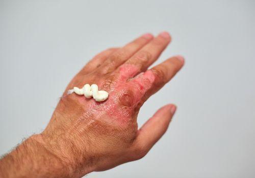 Domowe sposoby na oparzenia - co robić?