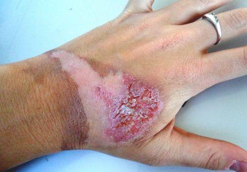 Blizny po oparzeniu - jak wyglądają i czy znikają całkowicie?