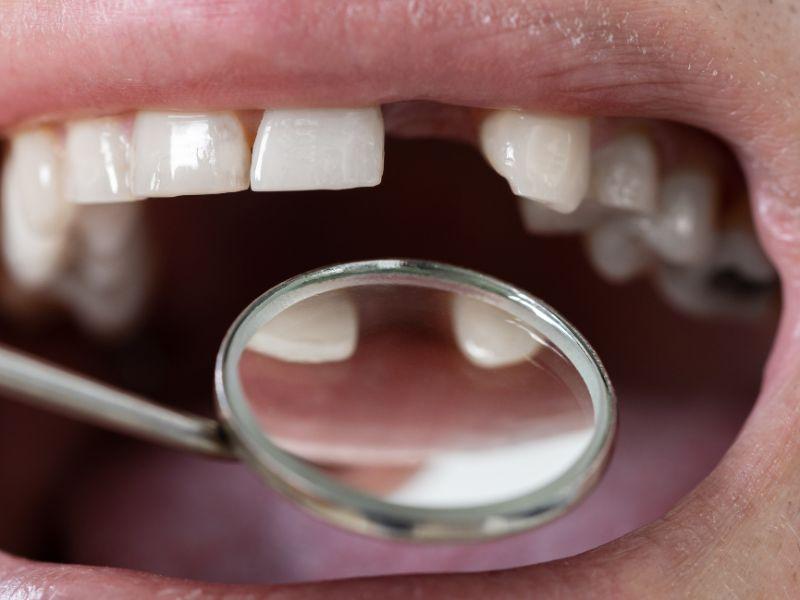 Braki w zębach można zniwelować – wystarczy wizyta u specjalisty