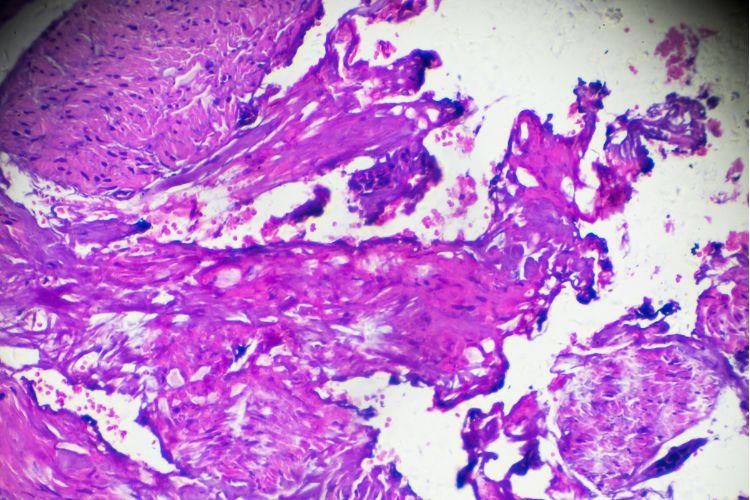 Biopsja prostaty – na czym polega, komu i po co się ją wykonuje (w tym fuzyjna)