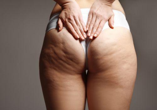 Naturalne metody walki z cellulitem