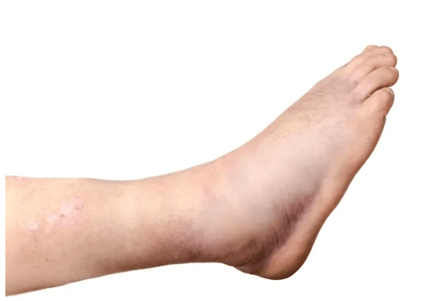 Obrzęk limfatyczny – leczenie i profilaktyka. Jak dbać o układ limfatyczny?