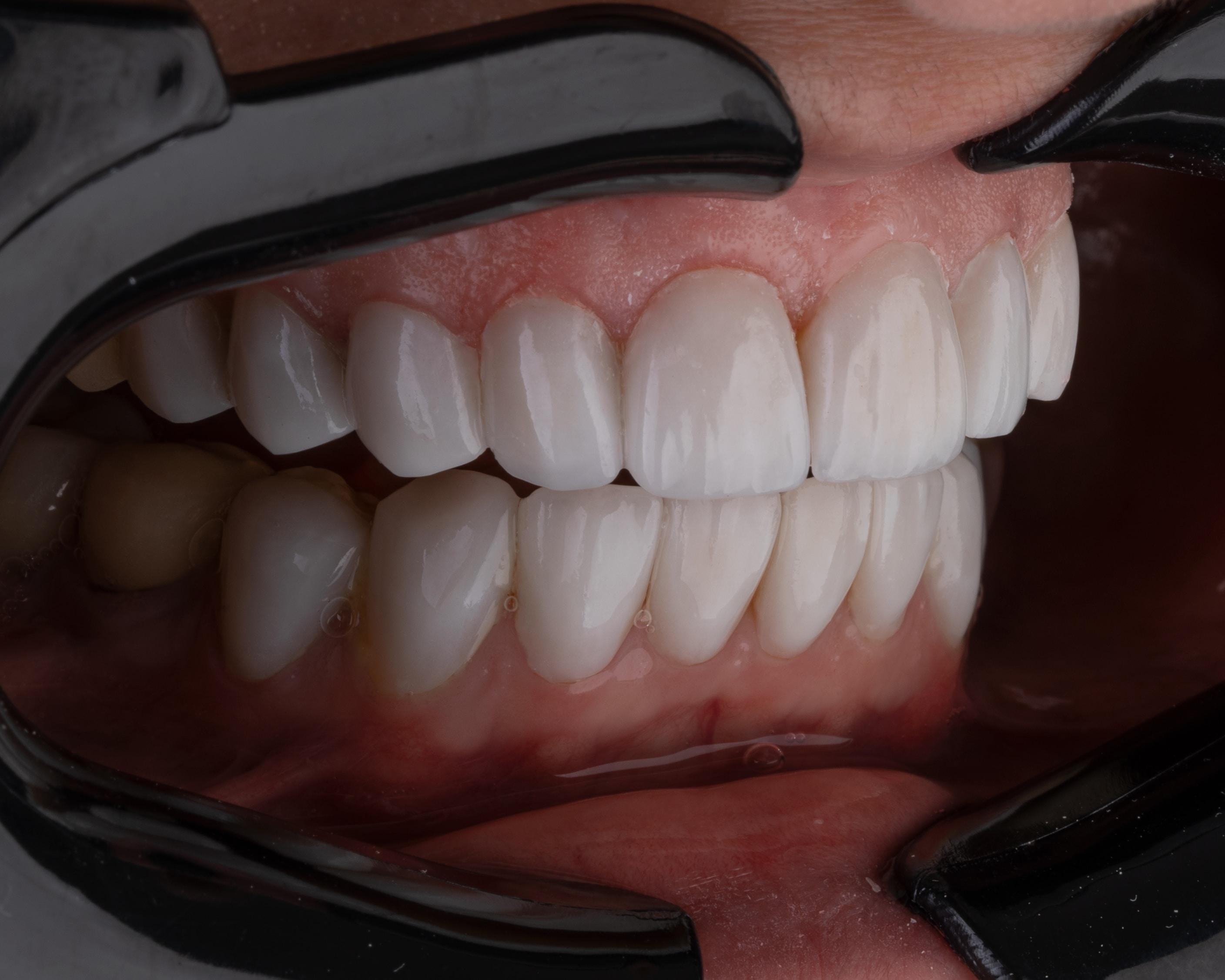 Wybielanie zębów w domu - jakie metody są najskuteczniejsze i najbezpieczniejsze? Skuteczne wybielanie zębów w domu. Jak wybielić zęby w domu? Domowe metody wybielania zębów. 