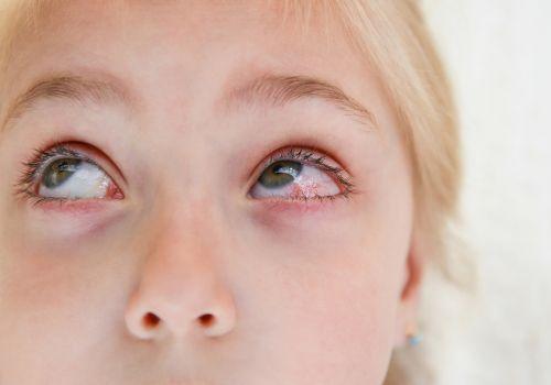 Zapalenie spojówek – czy jest zaraźliwe i jak je leczyć?