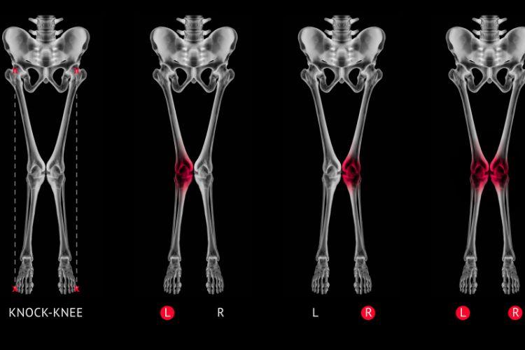 Koślawość kolan - przyczyny, objawy i leczenie u dorosłych i dzieci