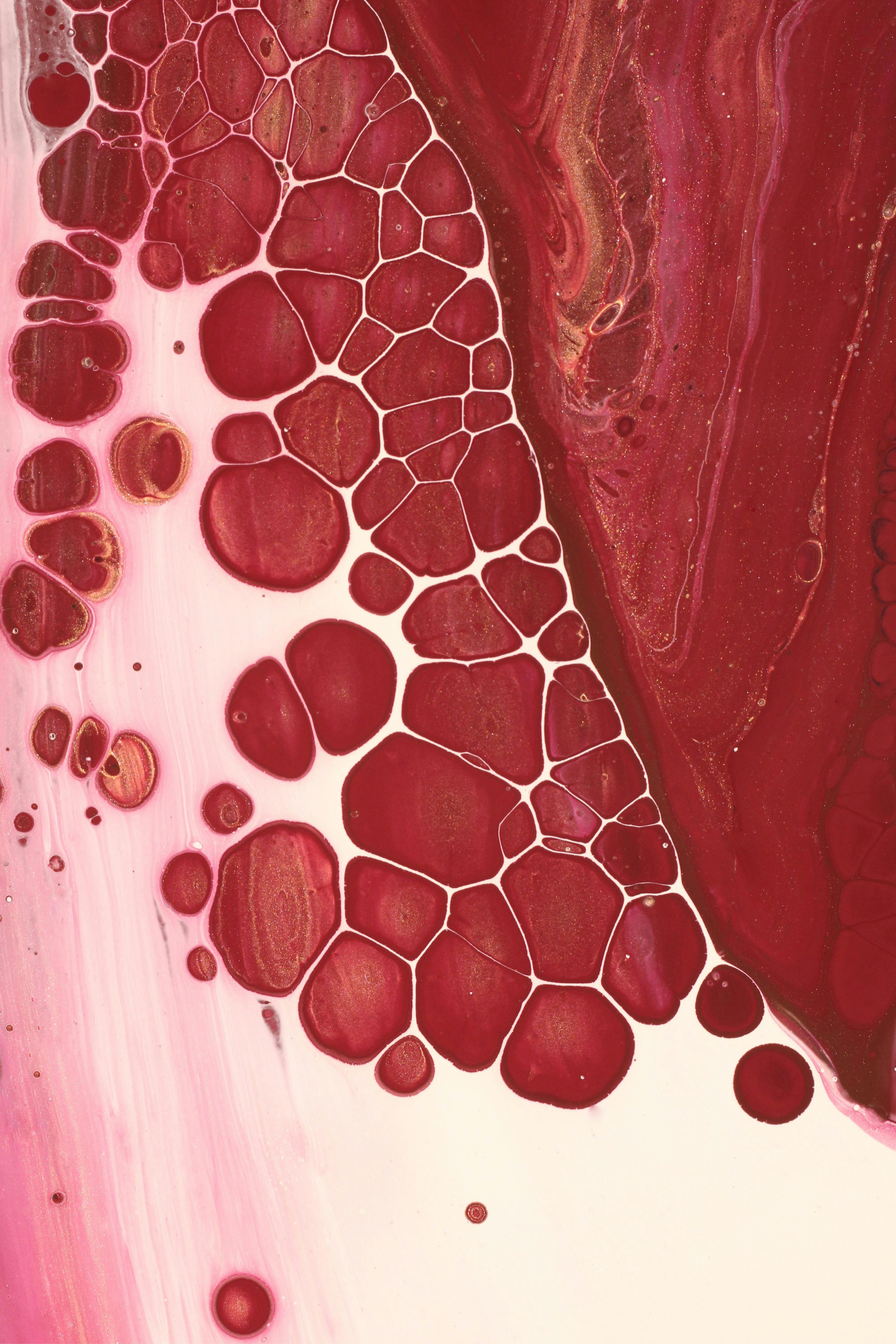 Hiperkalcemia – jak obniżyć poziom wapnia we krwi ?