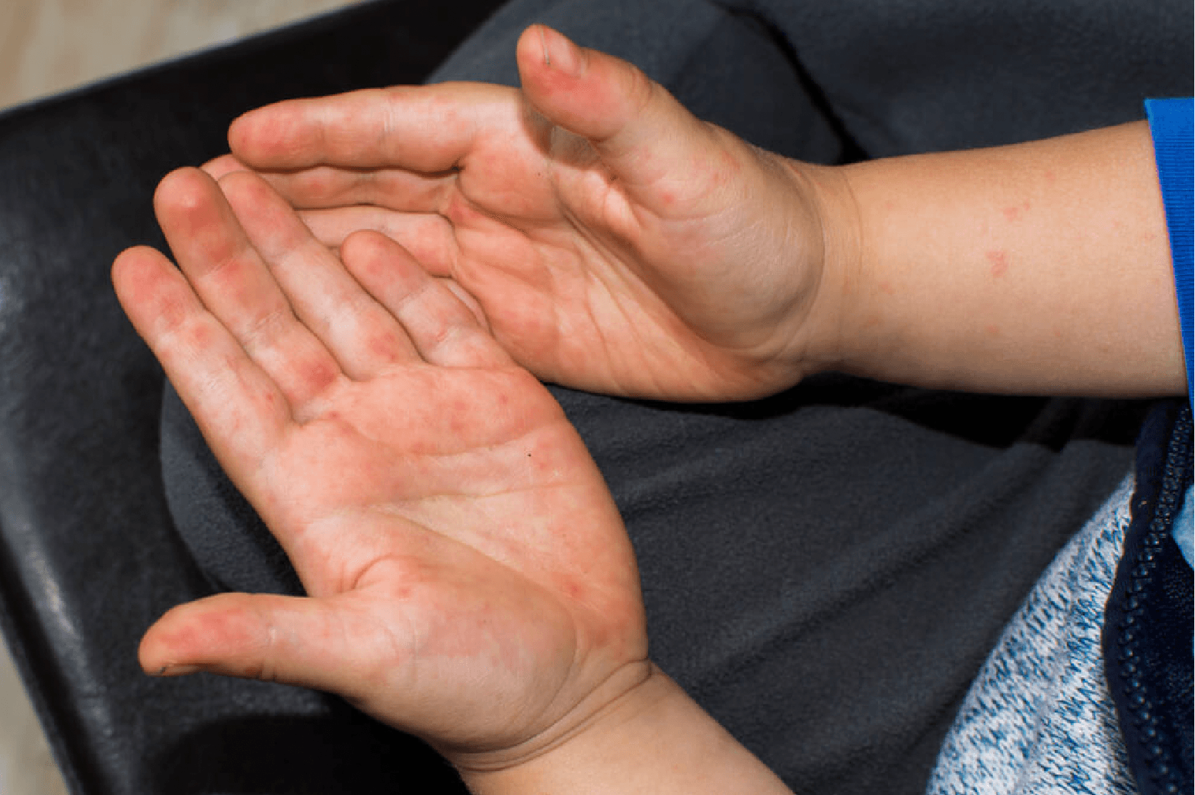 Jakie są objawy bostonki u dzieci i dorosłych