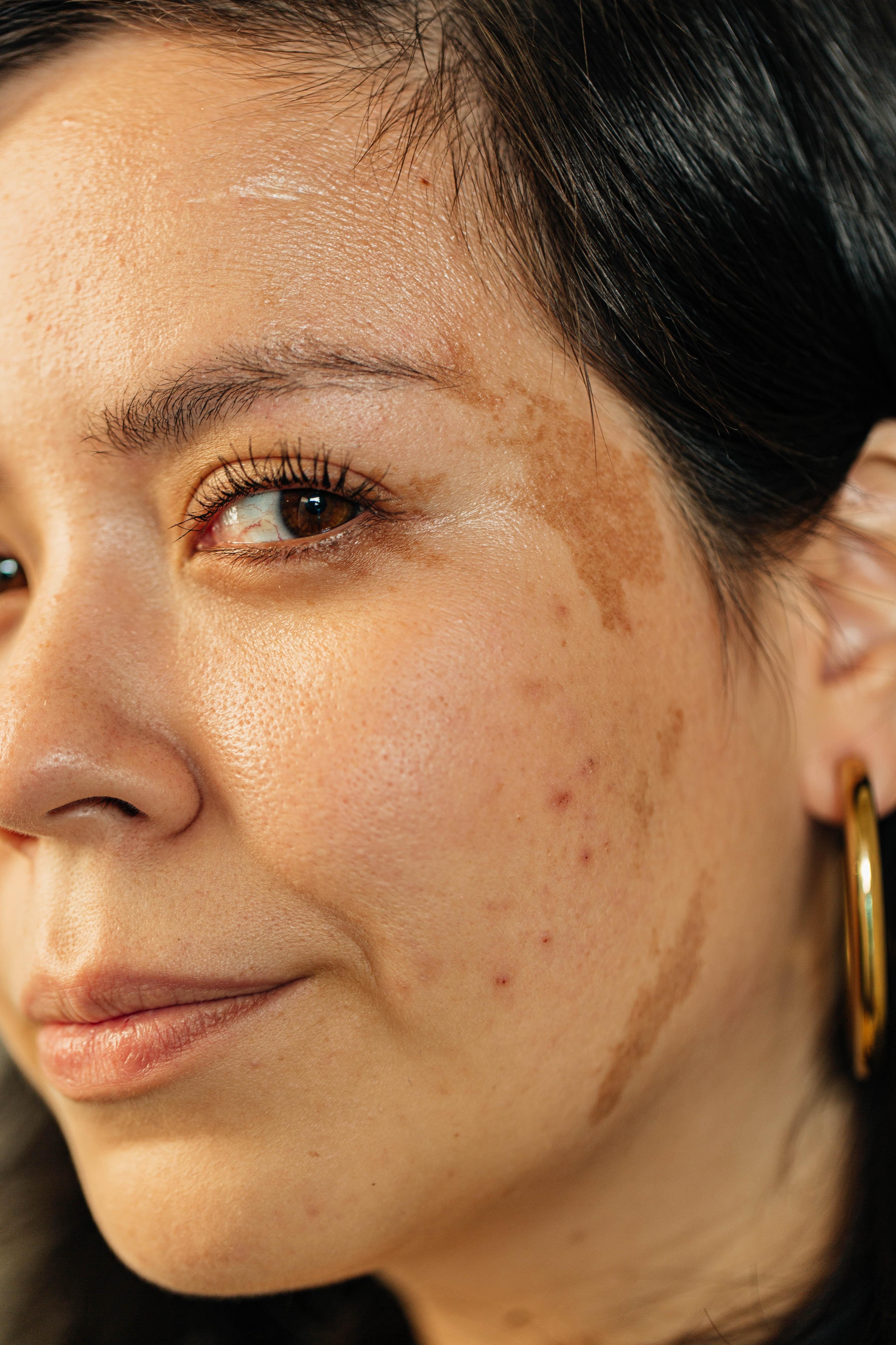 Przebarwienia na twarzy - jakie są rodzaje i domowe sposoby na przebarwienia Domowe sposoby na przebarwienia na twarzy zakładają też pielęgnację retinoidami w postaci ampułek, kremów czy serum. Jak pozbyć się przebarwień na twarzy? Jak usunąć przebarwienia na twarzy?