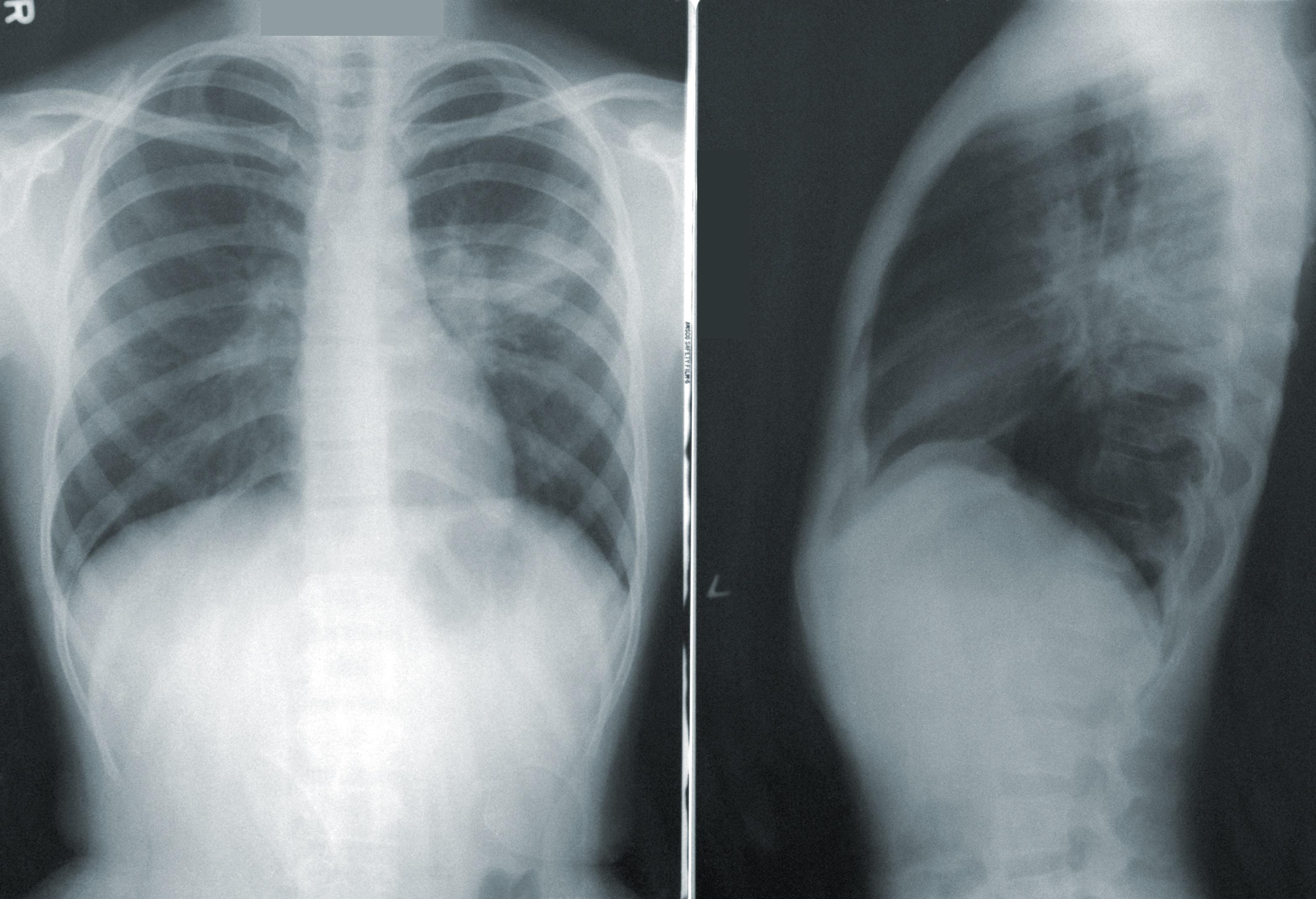 POChP - przewlekła obturacyjna choroba płuc - jakie są objawy i możliwości leczenia? 