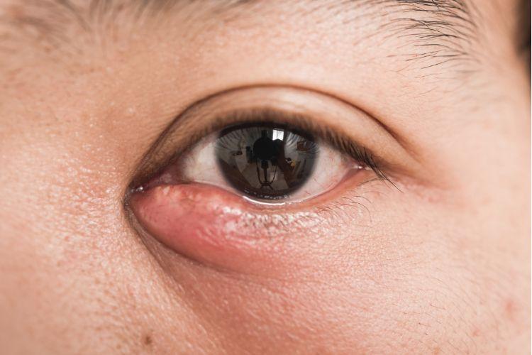Przyczyny jęczmienia na oku.Domowe sposoby na Jęczmień na oku. Domowe sposoby na jęczmień - zioła 