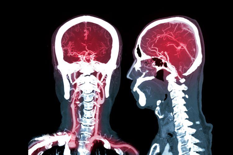 Tętniak mózgu – objawy, operacja i rekonwalescencja