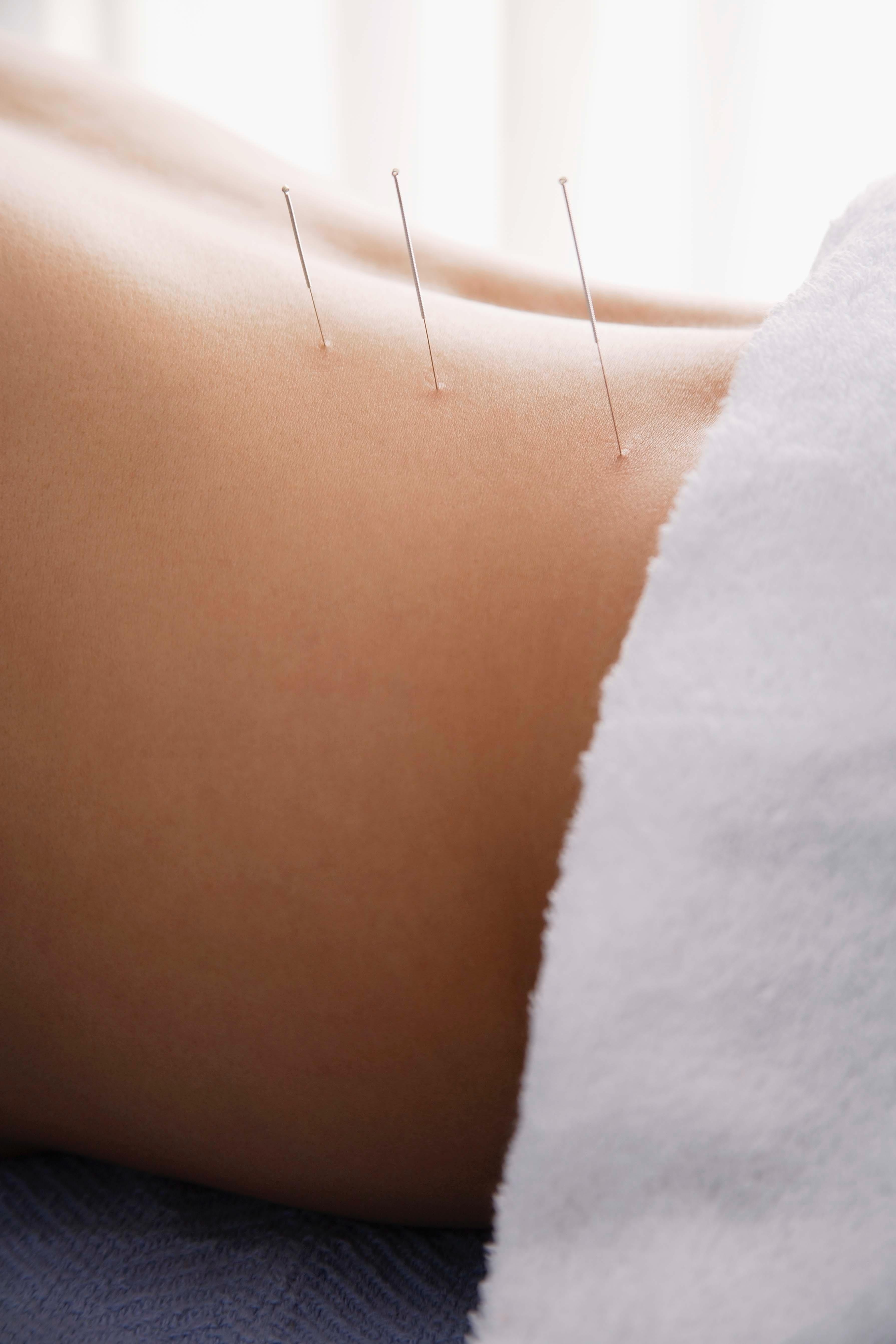Akupunktura - Na co pomaga? Akupunktura – na czym polega zabieg? Metoda leczenia poprzez nakłuwanie igłami. Skuteczny zabieg nakłuwania 