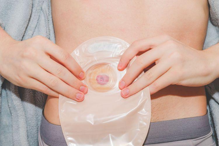 Stomia – kiedy się ją stosuje i jak pielęgnować