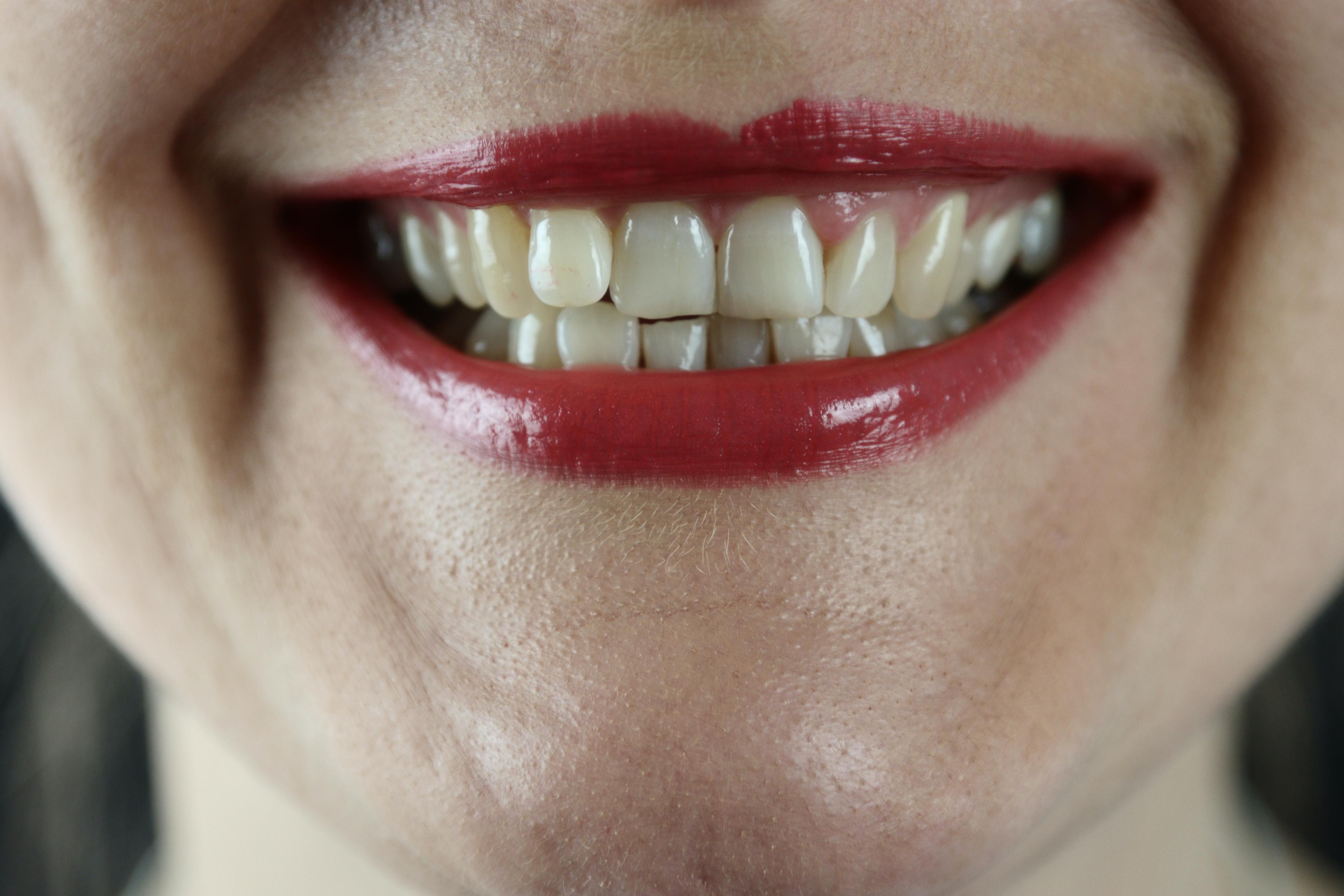 Co na nadwrażliwość zębów? Najlepsze sposoby i leczenie domowe. 4 domowe sposoby na nadwrażliwość zębów. Co pomaga na nadwrażliwe zęby – jakie domowe sposoby?