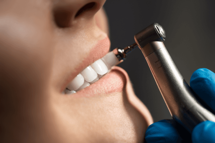 Skaling zębów - efekty przed i po. Czy warto robić skaling zębów?