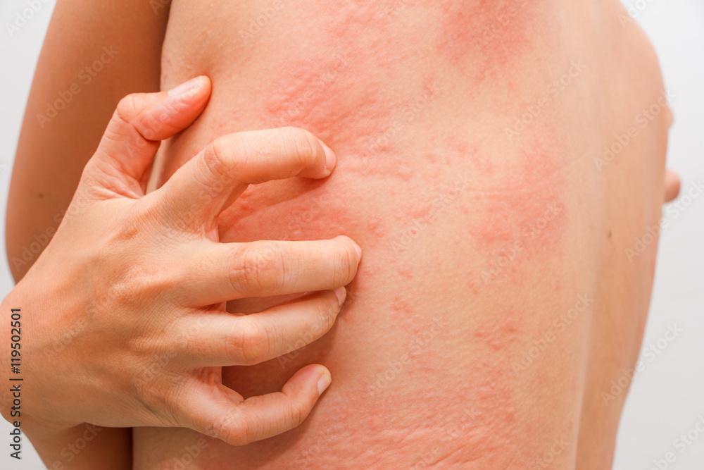 Jakie są objawy wysypki alergicznej?