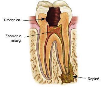 Mity na temat leczenia kanałowego zębów