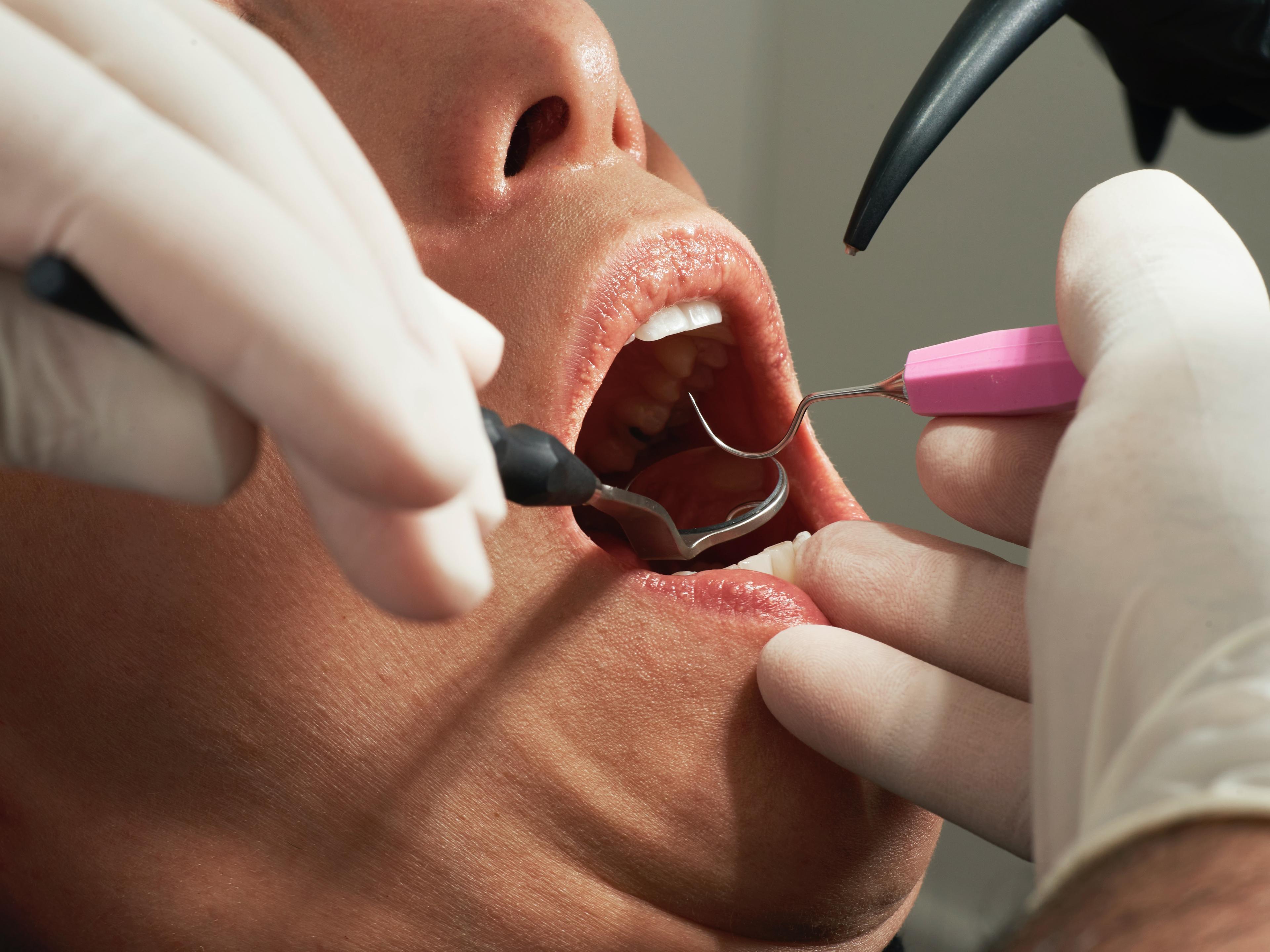 Odbudowa zębów - jakie są metody? Odbudowa zęba na korzeniu. Metody odbudowy zęba. Odbudowa zęba – metody odbudowy korony zęba 