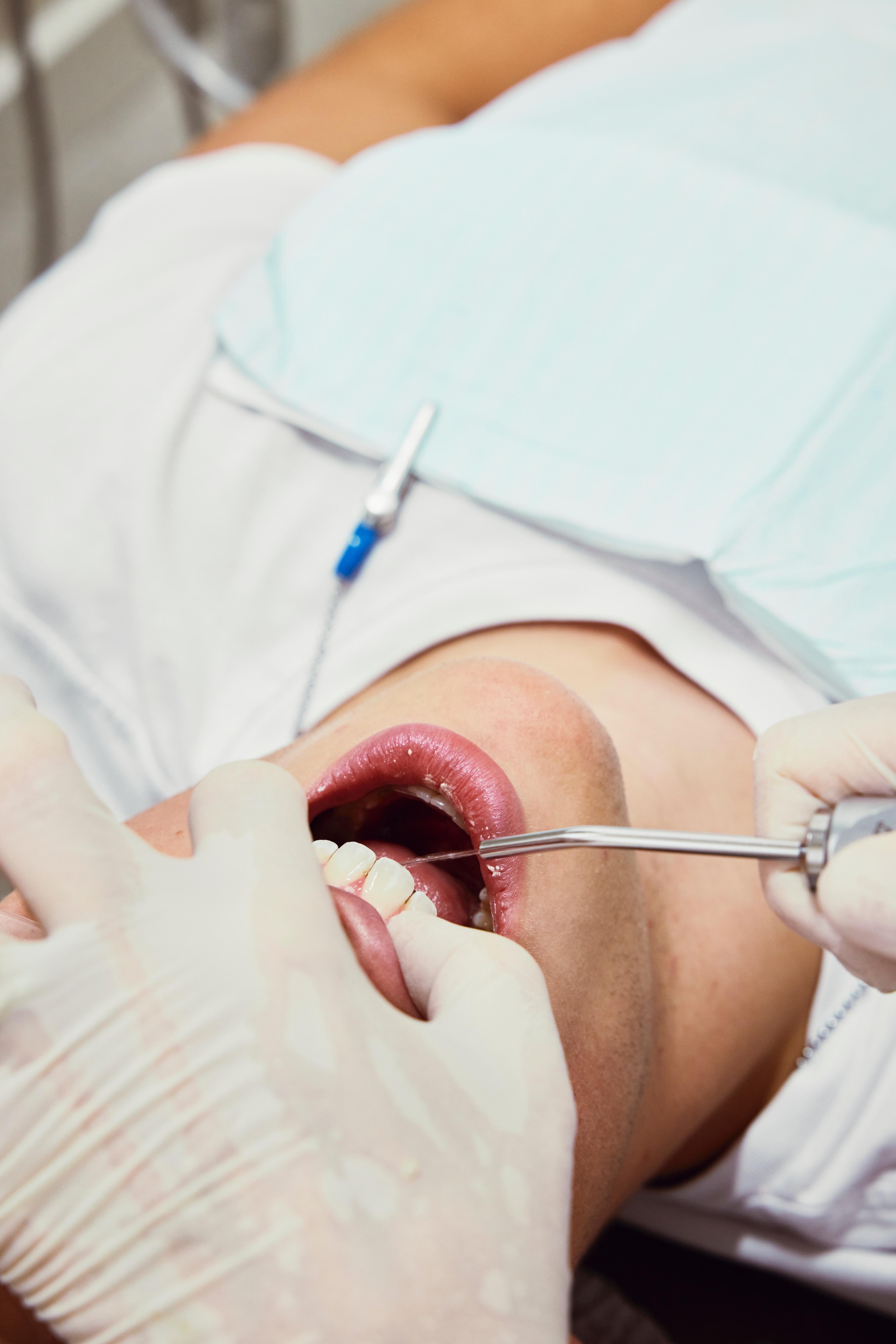 Próchnica zębów - jak wygląda u dzieci i dorosłych? Leczenie próchnicy. Próchnica u dzieci - objawy i leczenie próchnicy zębów mlecznych. Leczenie próchnicy zębów u dzieci