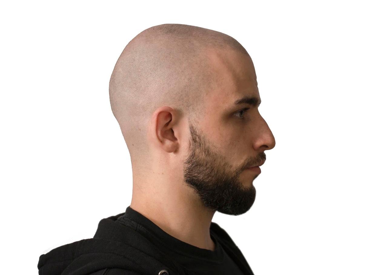 Mikropigmentacja skóry głowy – innowacyjne rozwiązanie w walce z łysieniem