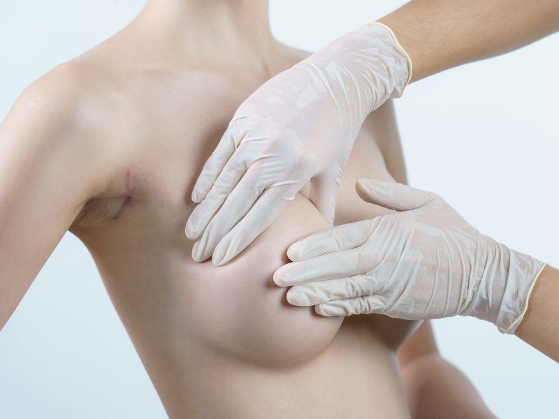 Plastyka piersi popularna wśród Polek – to już norma