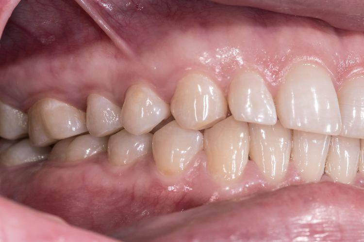 Zgryz krzyżowy – czym się objawia i jak leczyć?