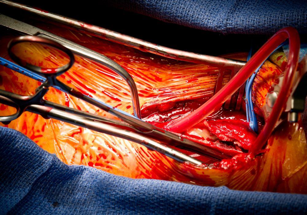 Endarterektomia – co to jest, wskazania, przebieg. Angioplastyka i stentowanie tętnic szyjnych