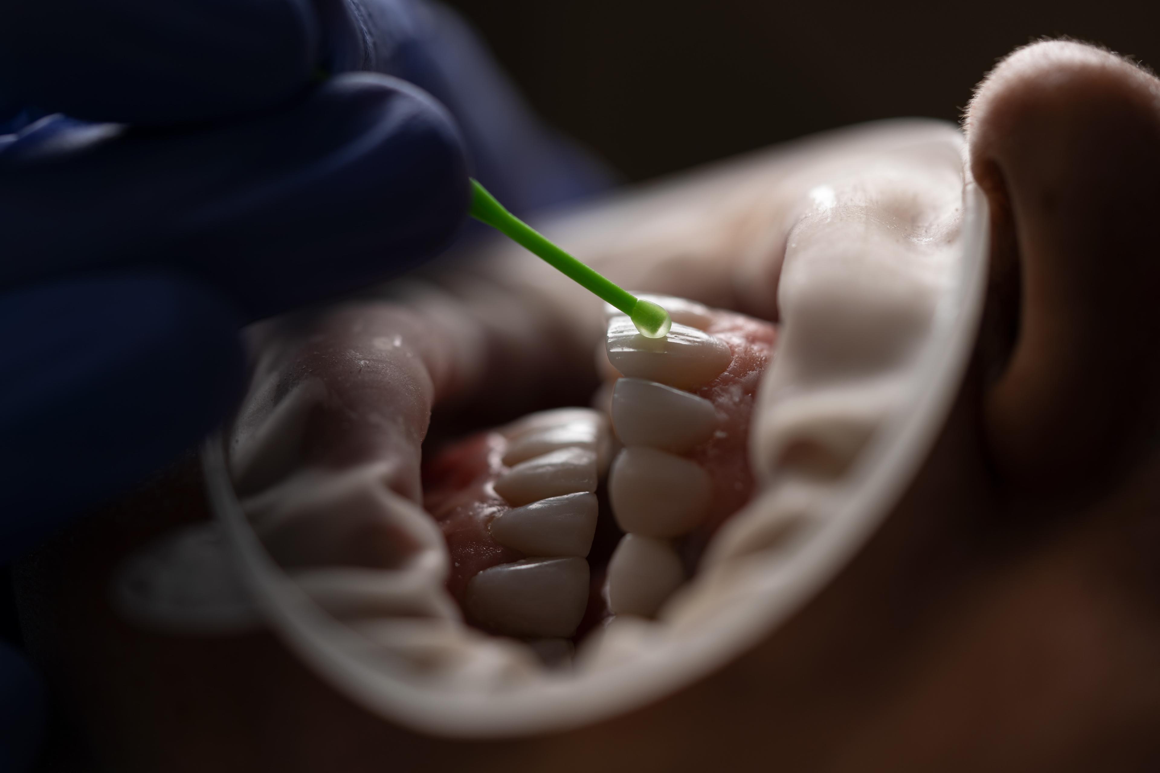 Fluoroza zębów - jakie są objawy, możliwości leczenia i skąd się bierze? Różnice między fluorozą a odwapnieniem. Białe plamy na zębach u dziecka – hipomineralizacja. Jak odróżnić fluorozę od odwapnienia szkliwa? Białe plamy próchnicowe