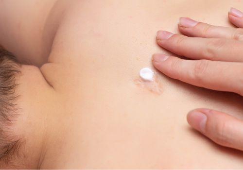 Jakie maści na blizny stosować? Rodzaje maści na blizny