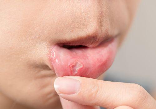 Jakie są domowe sposoby na afty?